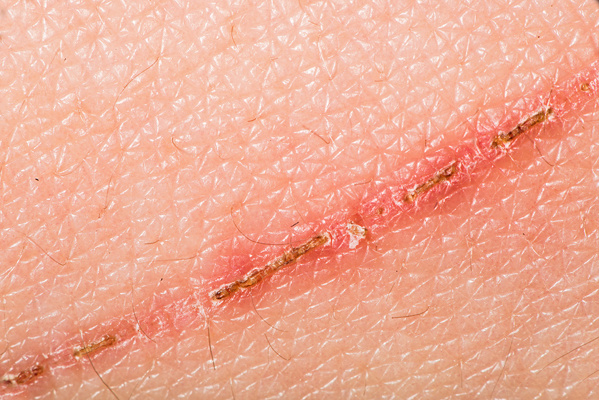 Zigzag cuts heal faster and have a different healing mechanism – scientists