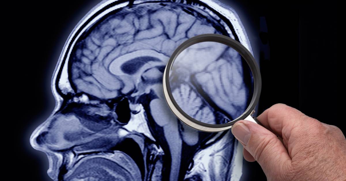 Scientists have discovered a new method of spreading Alzheimer’s disease between people