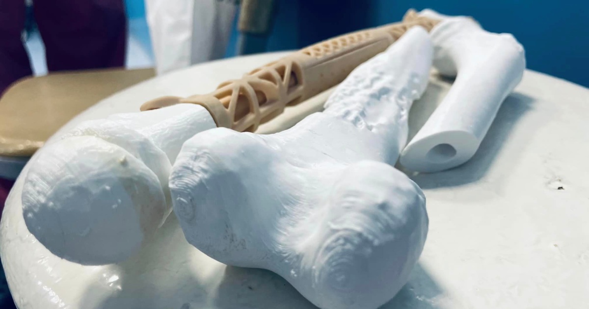 In Lviv, a boy with cancer was transplanted with a bone printed on a 3D printer