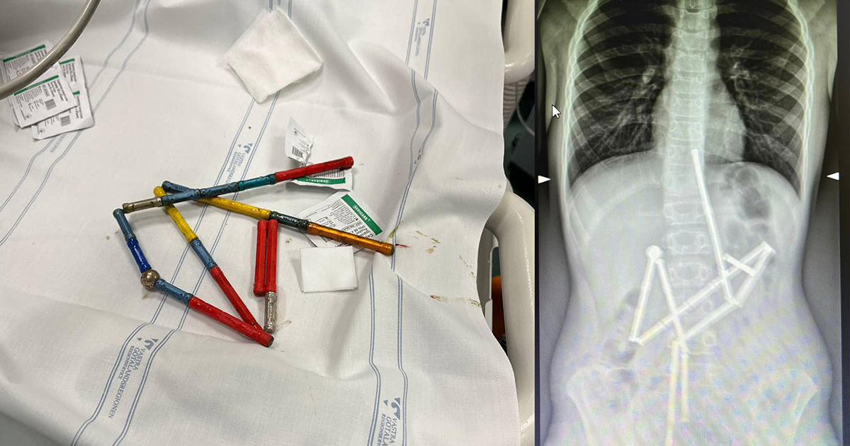 Dangerous toys: in Kyiv, doctors saved a boy who swallowed 20 magnets