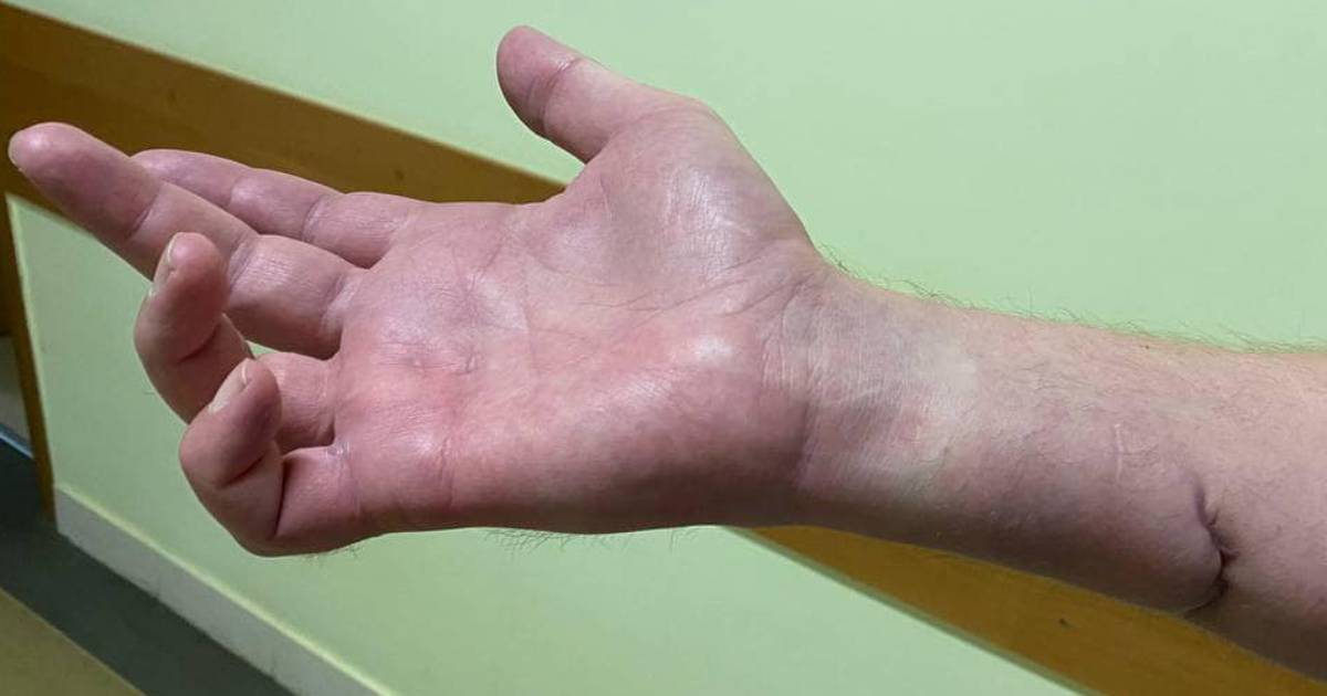 A nerve was transplanted from the thigh to the hand: in Lviv, doctors save the sensitivity of the fingers of a wounded soldier